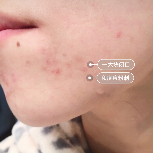 痘痘肌的护肤小技巧 (痘痘肌手把手教你护肤)