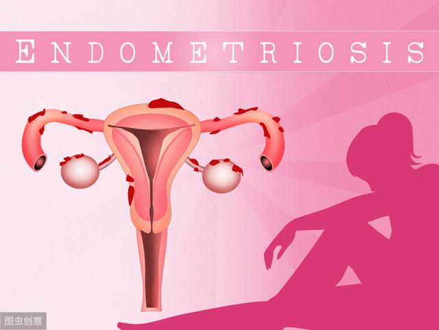 子宫腺肌症「不死的癌症」——介入栓塞来帮忙