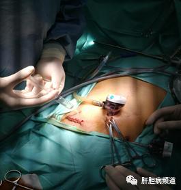 晚期胃癌转移卵巢怎么办,晚期胃癌转移肝有必要治疗么