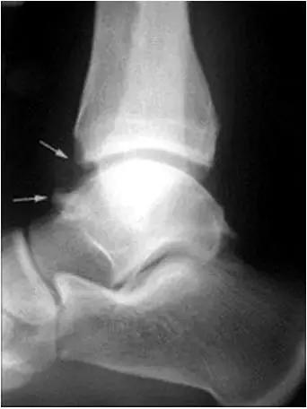 踝关节撞击症问诊,踝关节内侧撞击综合症位置图