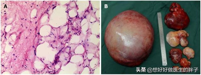 脂肪瘤长得比较快是因为恶变了吗,长了一个脂肪瘤必须赶紧做手术吗