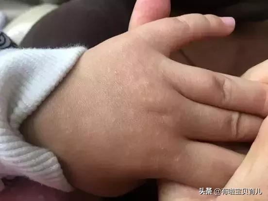 麻疹样幼儿急疹,麻疹风疹幼儿急疹的鉴别点有哪些