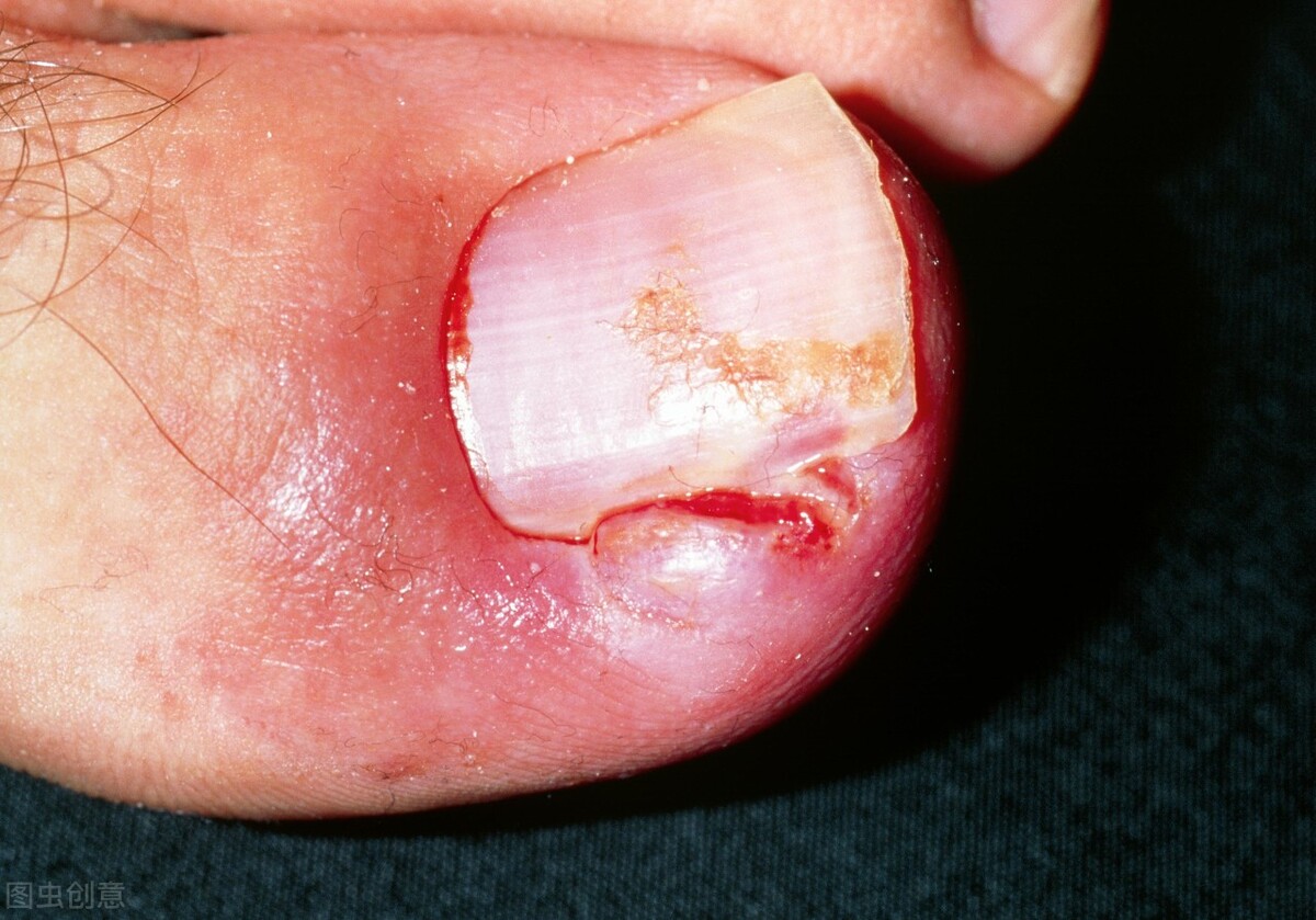 脚趾甲甲根处嵌甲怎么治疗,脚趾甲老往肉里长是缺什么吗