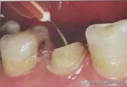 纤维桩修复费用,纤维桩修复全过程视频