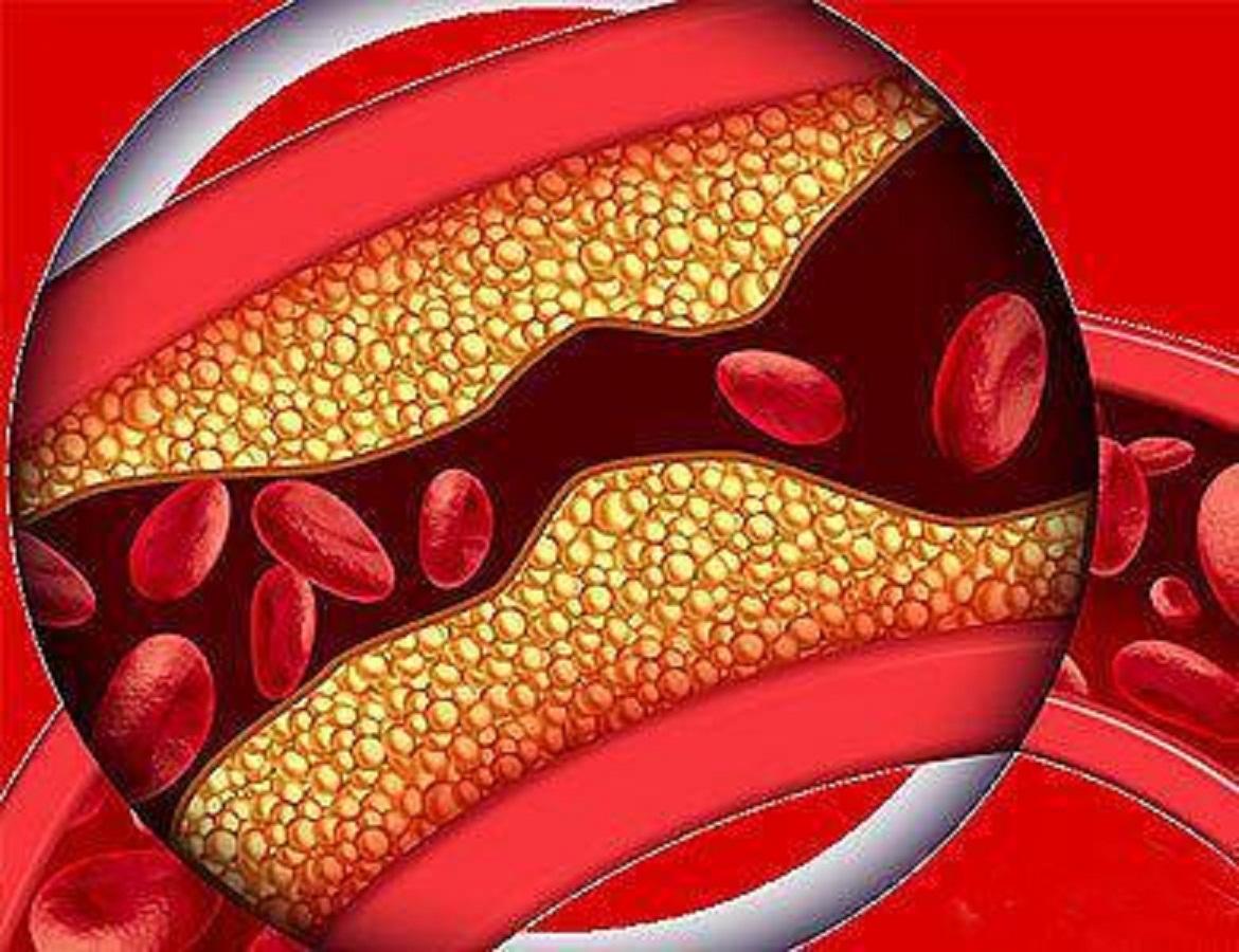 脑梗塞恢复到什么程度可以出院,脑梗塞出院后在家吃什么药