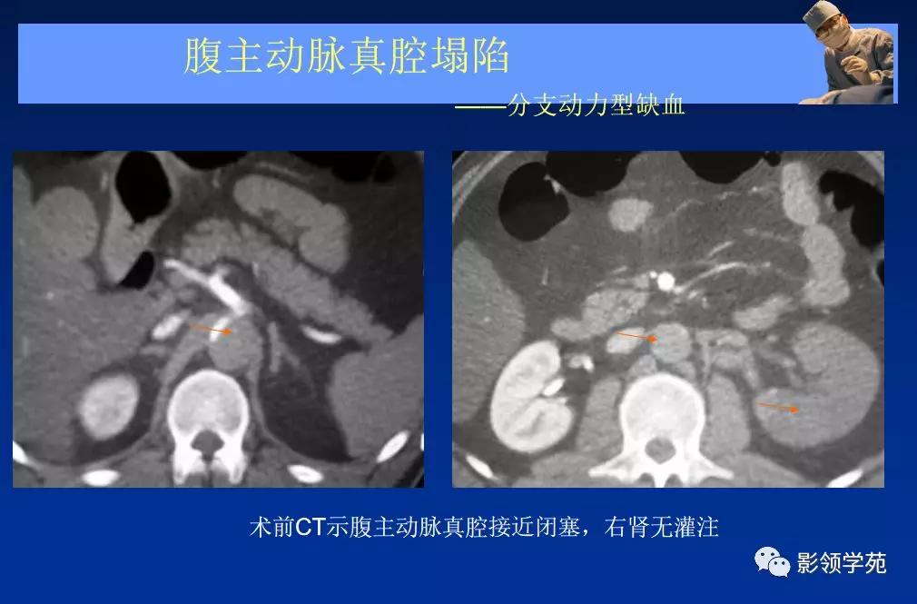 主动脉夹层壁间血肿如何鉴别,主动脉夹层血肿溃疡