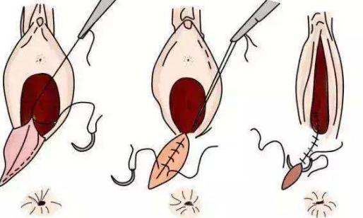 伤口侧切裂开怎么护理,孕妇侧切伤口如何护理