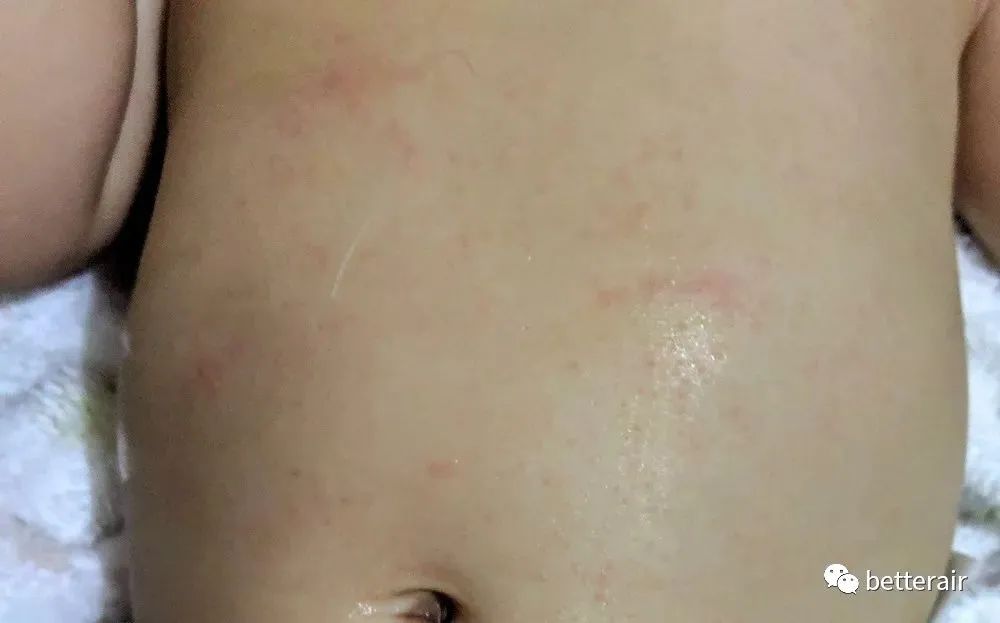 宝宝湿疹咳嗽流涕减轻,宝宝湿疹反复奇痒难忍