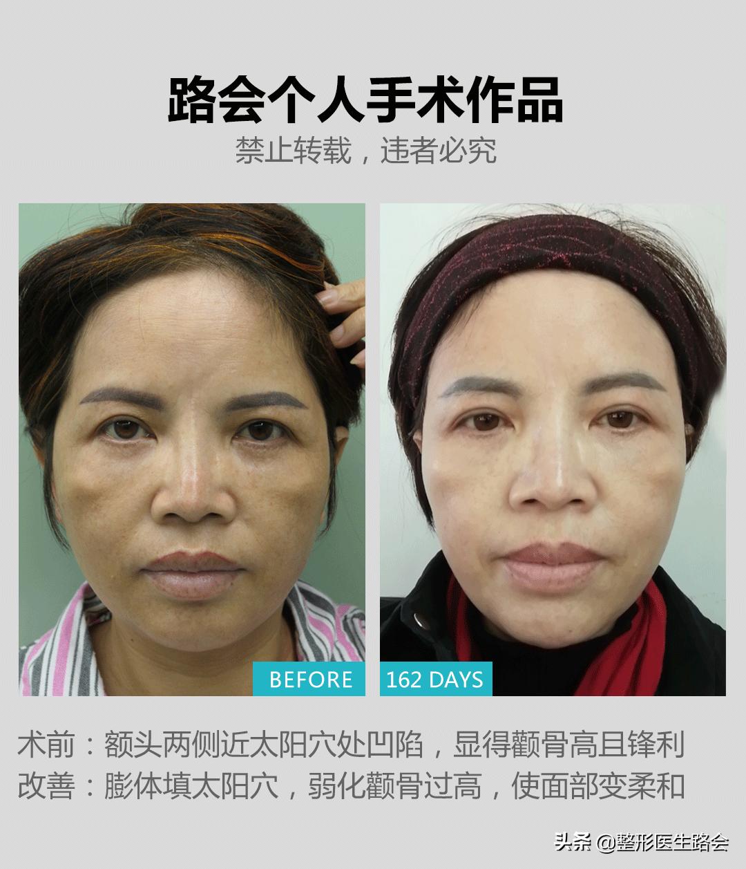 颧骨高到底需不需要整容,颧骨高到底要不要磨骨