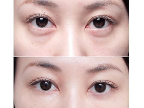 “祛眼袋”这件事,说实话还是手术靠谱