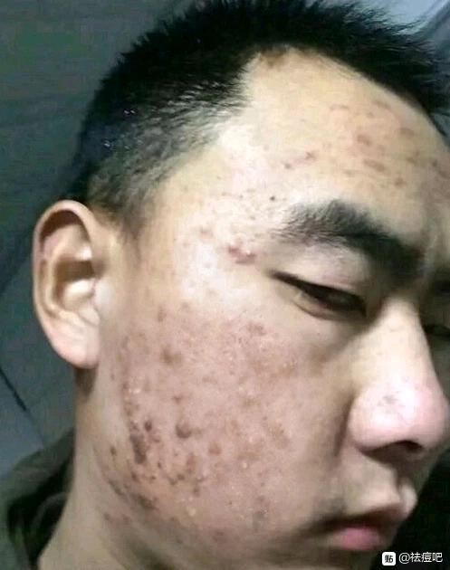 祛痘治疗后恢复,祛痘可以治好痘痘吗