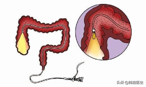 肠梗阻x线鉴别诊断,肠梗阻病人护理诊断