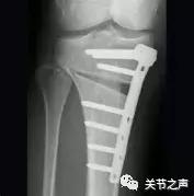 膝关节骨关节炎的阶梯型治疗方案,膝骨关节炎阶梯式治疗