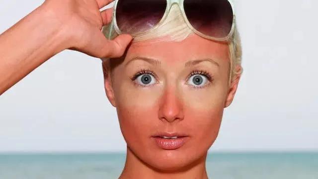 晒黑晒伤不要慌,快准狠修复晒后“关公脸”