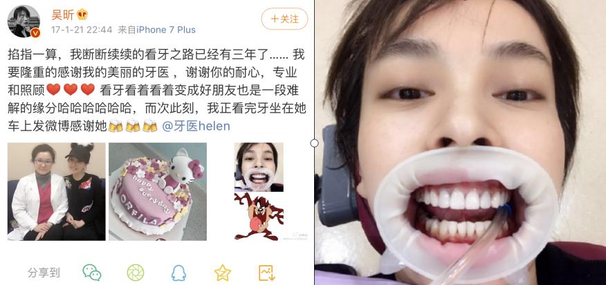 刘涛是全口瓷牙,演员刘涛的一口烤瓷牙多少钱