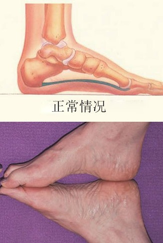 扁平足穿什么鞋都痛吗,扁平足穿什么鞋可以矫正