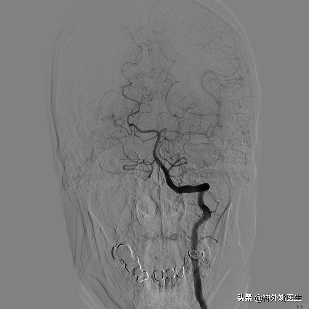 颈内动脉狭窄内膜剥脱术风险大吗,颈动脉内膜摘除手术