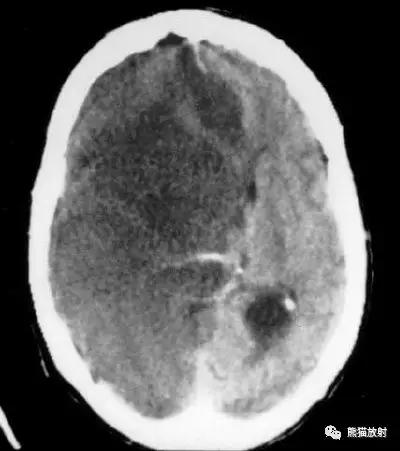 脑梗死丨演变、血供区域分布、CT表现