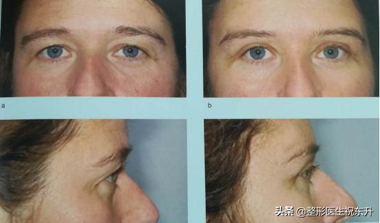 上眼皮松弛预示十种疾病,上眼皮松弛显凶