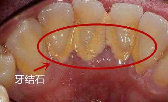 牙龈刷牙出血吃啥药,牙龈出血刷牙出血用什么牙膏