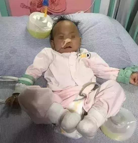 四岁小男孩切除150cm小肠,小孩子吃完饭剧烈运动急性肠梗阻