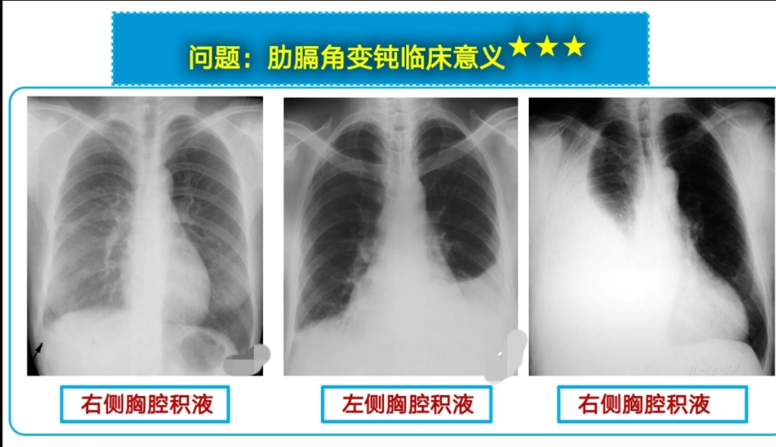 如何通过胸片判断胸腔积液量?