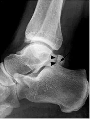 踝关节撞击症问诊,踝关节内侧撞击综合症位置图