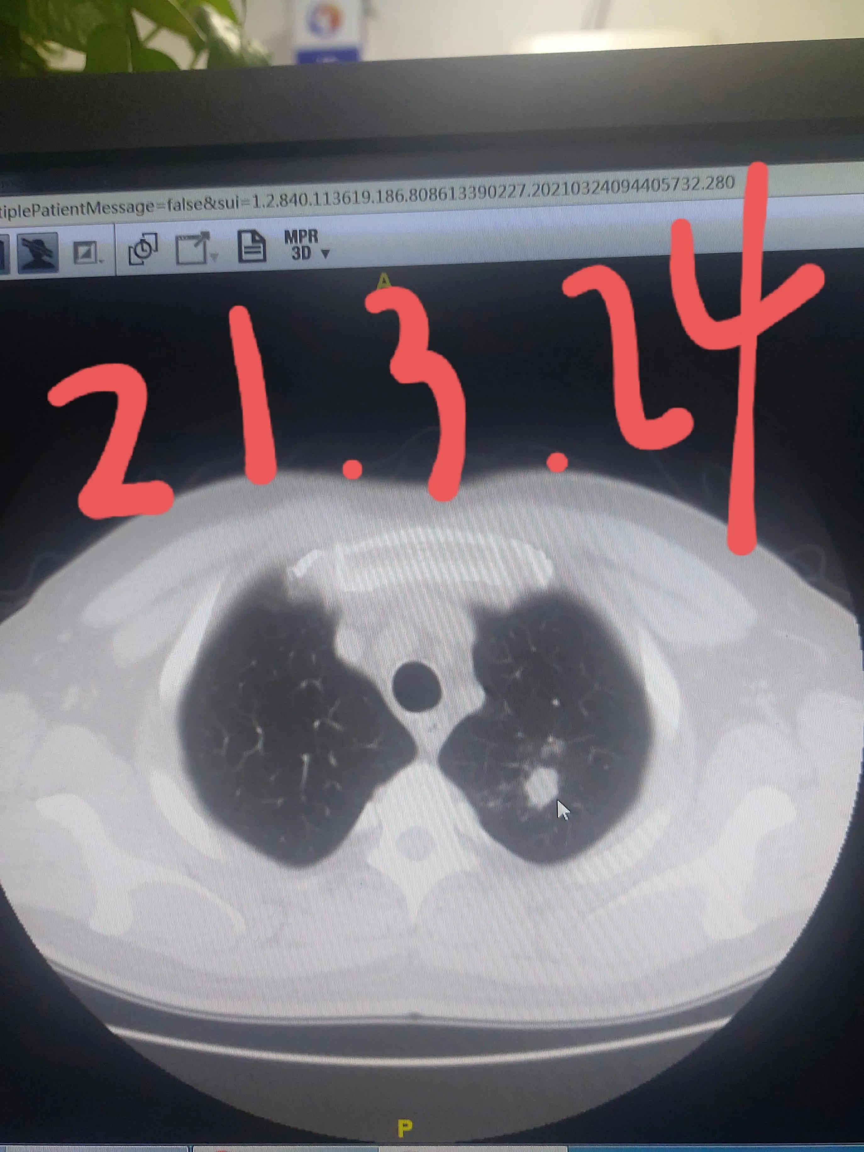 刘懿博士肺癌治疗,刘懿博士说肺癌晚期合并脑梗