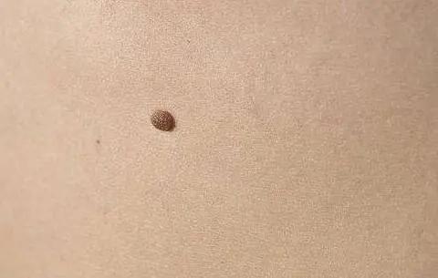 哪些黑痣容易恶变?需要切除吗?