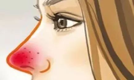 菌群问题,过敏与肠道菌群失调有关吗