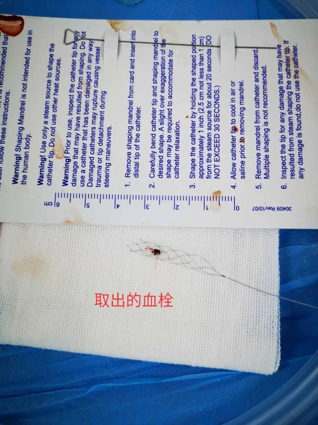 经皮颅内动脉取栓术全过程,为患者打开生命希望之门