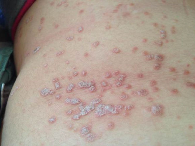 得玫瑰糠疹该如何治最好,红色糠疹和玫瑰糠疹区别