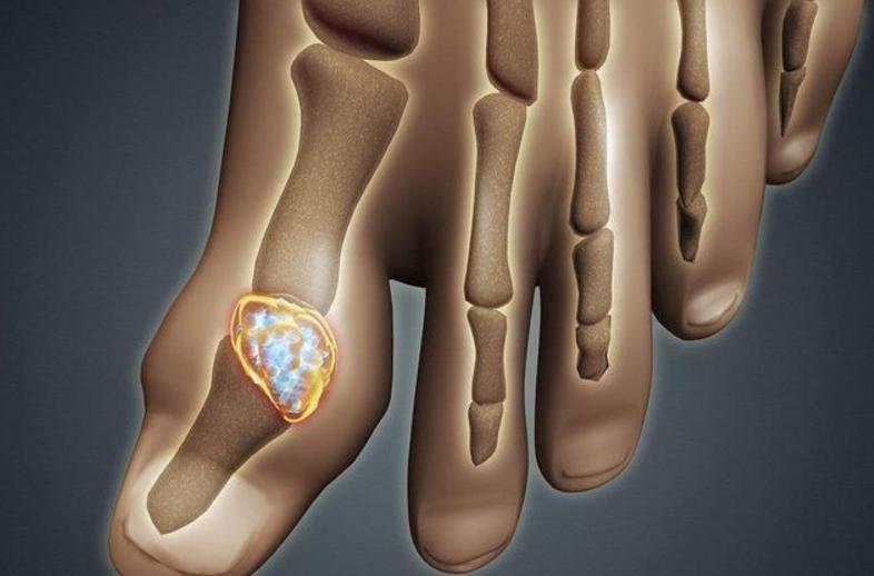 痛风首次发作和二次发作间隔多久,痛风总反复发作该怎么办才好