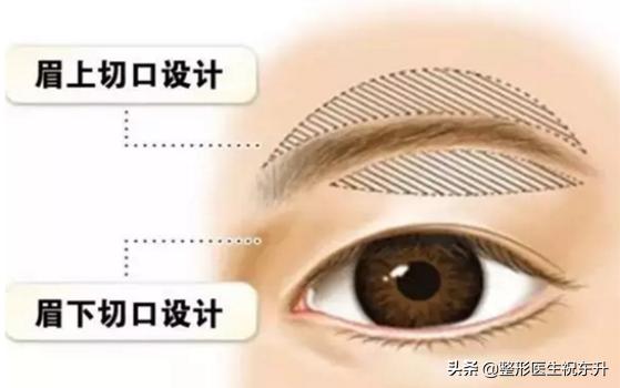 45岁上眼皮下垂的解决方法,51岁眼皮下垂怎么办