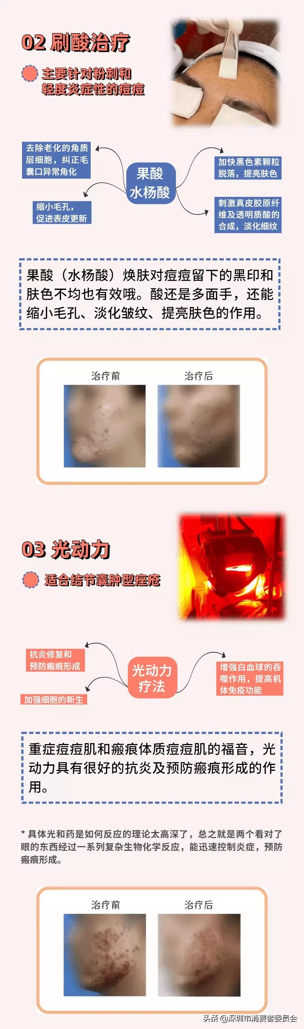 这些小技巧对付痘痘绰绰有余,怎样和青春痘说拜拜