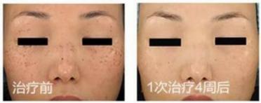 皮秒了解,皮秒使用方法教程