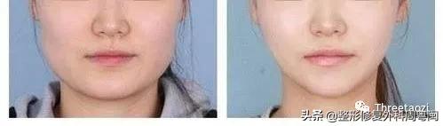 瘦脸针刚打完脸会不会比之前要大,打完溶脂针瘦脸针有一边脸僵了