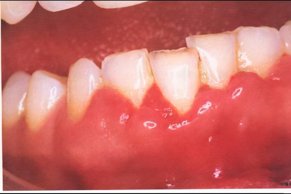 牙龈出血是什么病的征兆,牙龈经常出血是什么原因