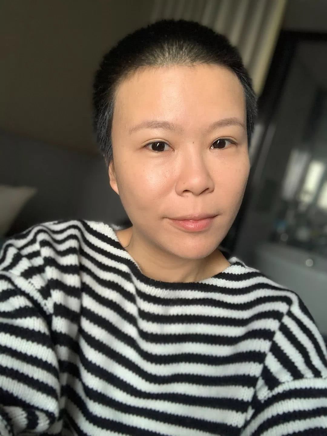 号称“1小时逆龄10年”的微整？我亲身体验了