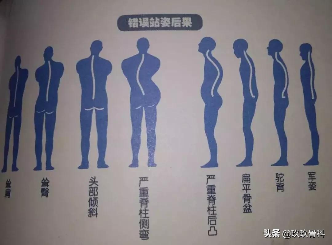 颈椎治疗法——麦肯基疗法