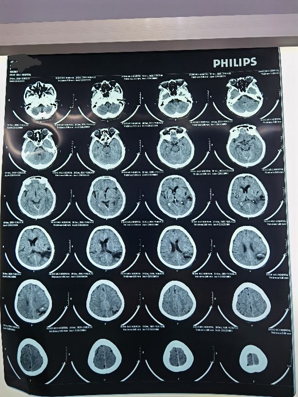 硬脑膜外血肿引流,高压氧治疗颅内出血