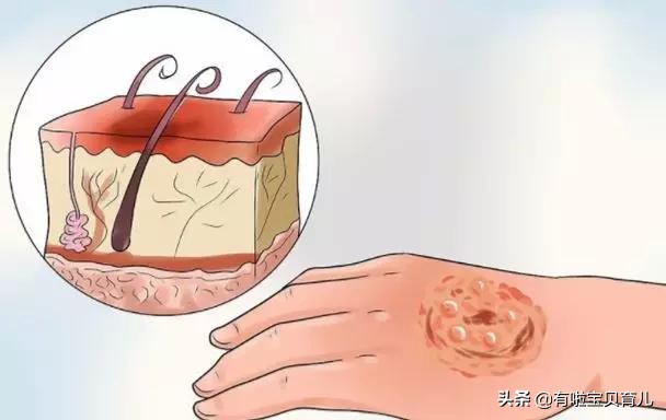 宝宝被烫伤第十三天,宝宝被开水烫伤要打针吗
