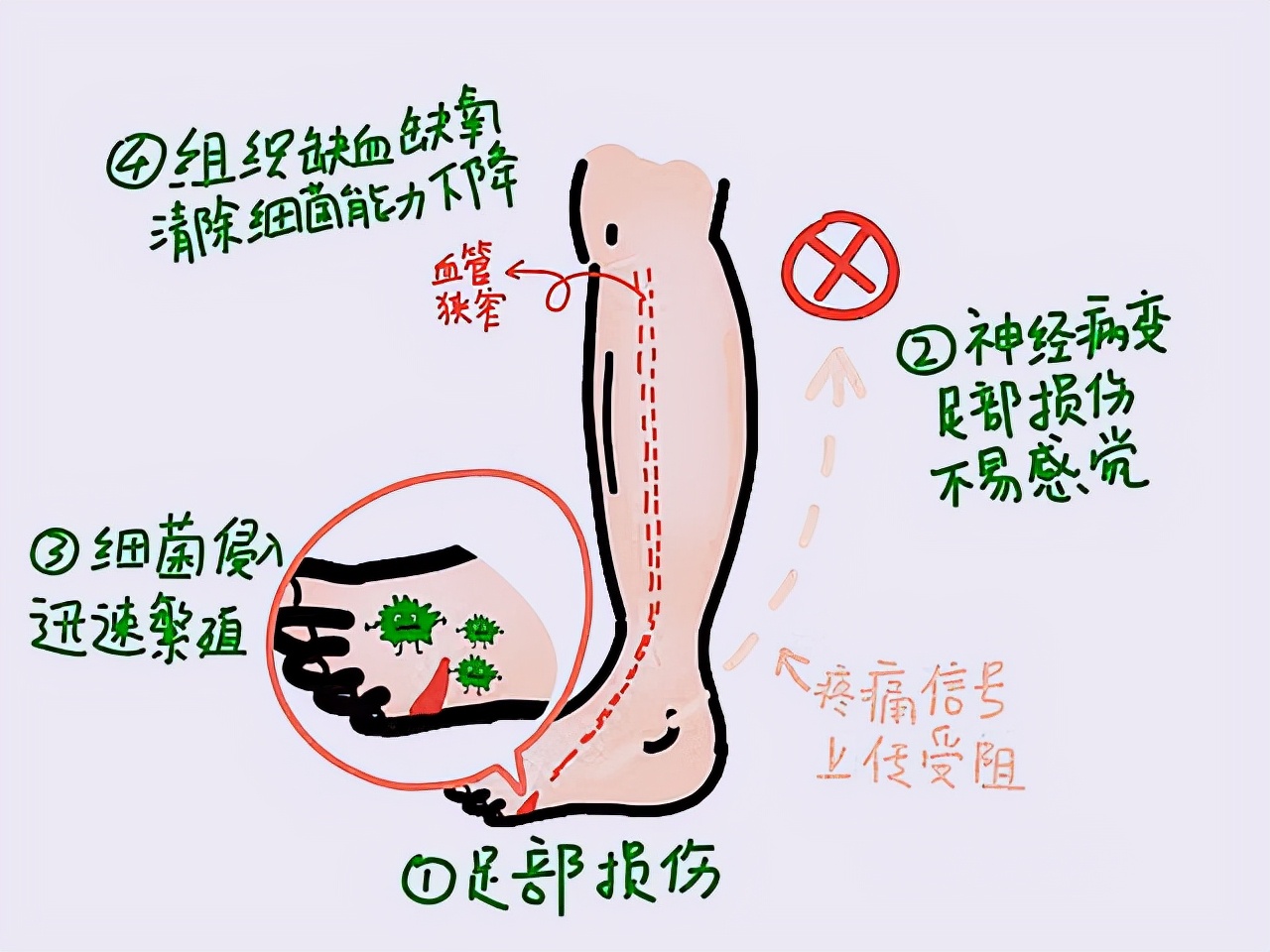 糖友穿的鞋,糖友适合穿什么鞋