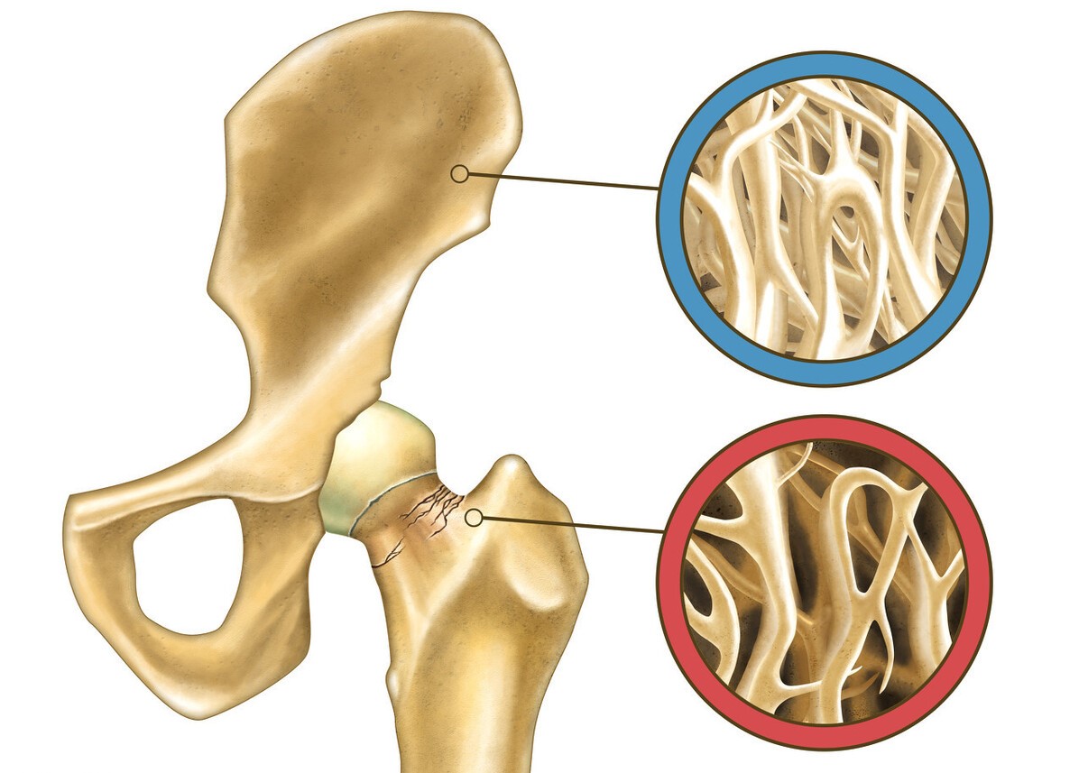 治疗腿疼的氨糖有哪些,腿疼长期吃氨糖可以吗