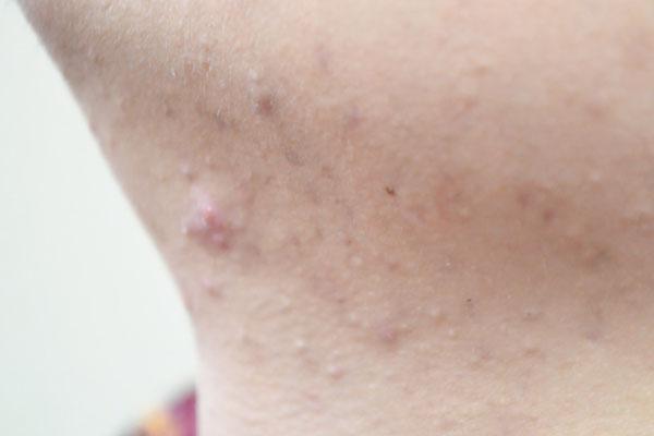 下巴上密密麻麻的小疙瘩是什么,脖子下巴长硬硬的疙瘩怎么回事