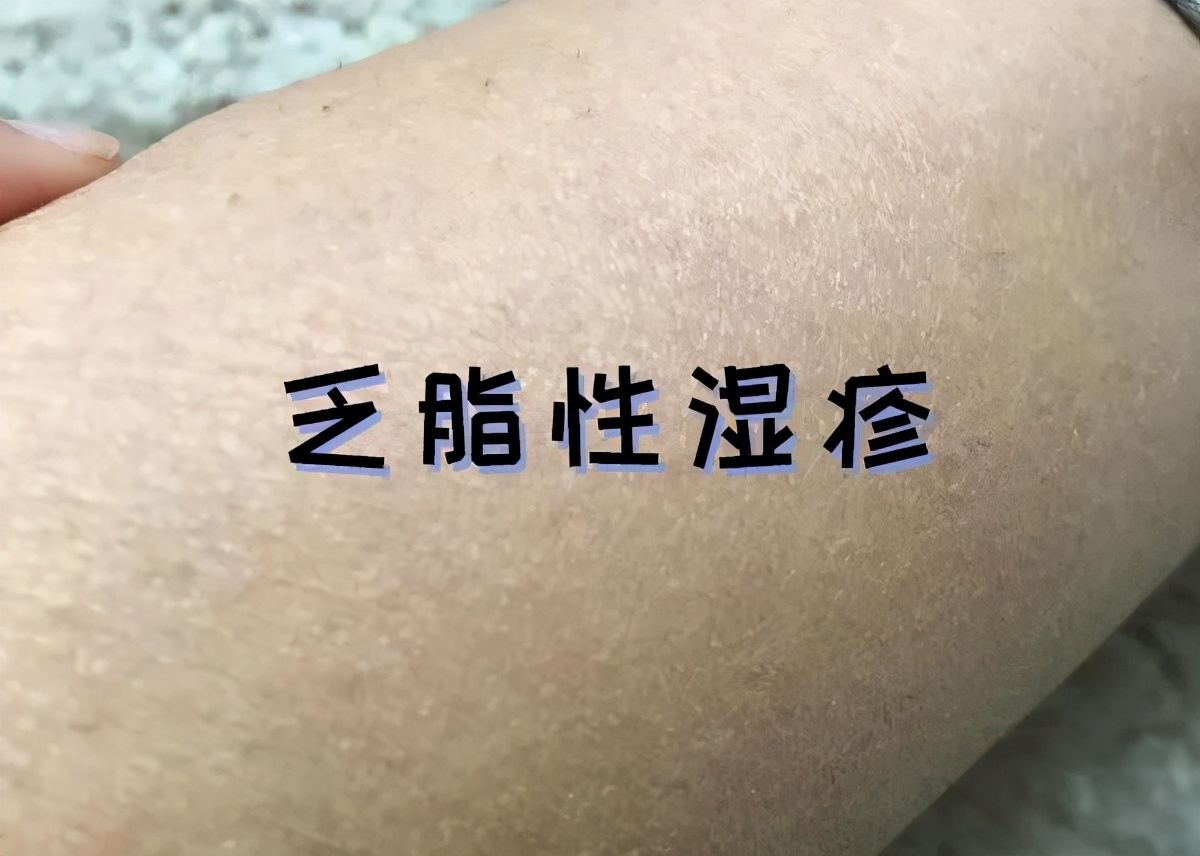 秋冬皮肤干燥湿疹怎么解决,冬季皮肤干燥性湿疹是什么引起的
