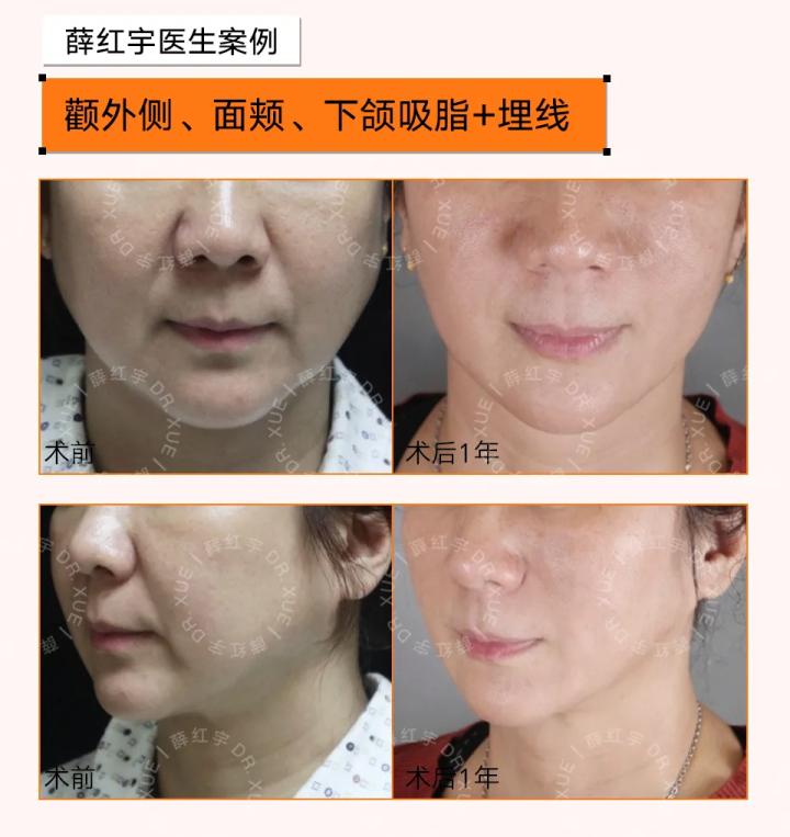 面部吸脂可以瘦脸,面部吸脂全脸什么部位不能吸