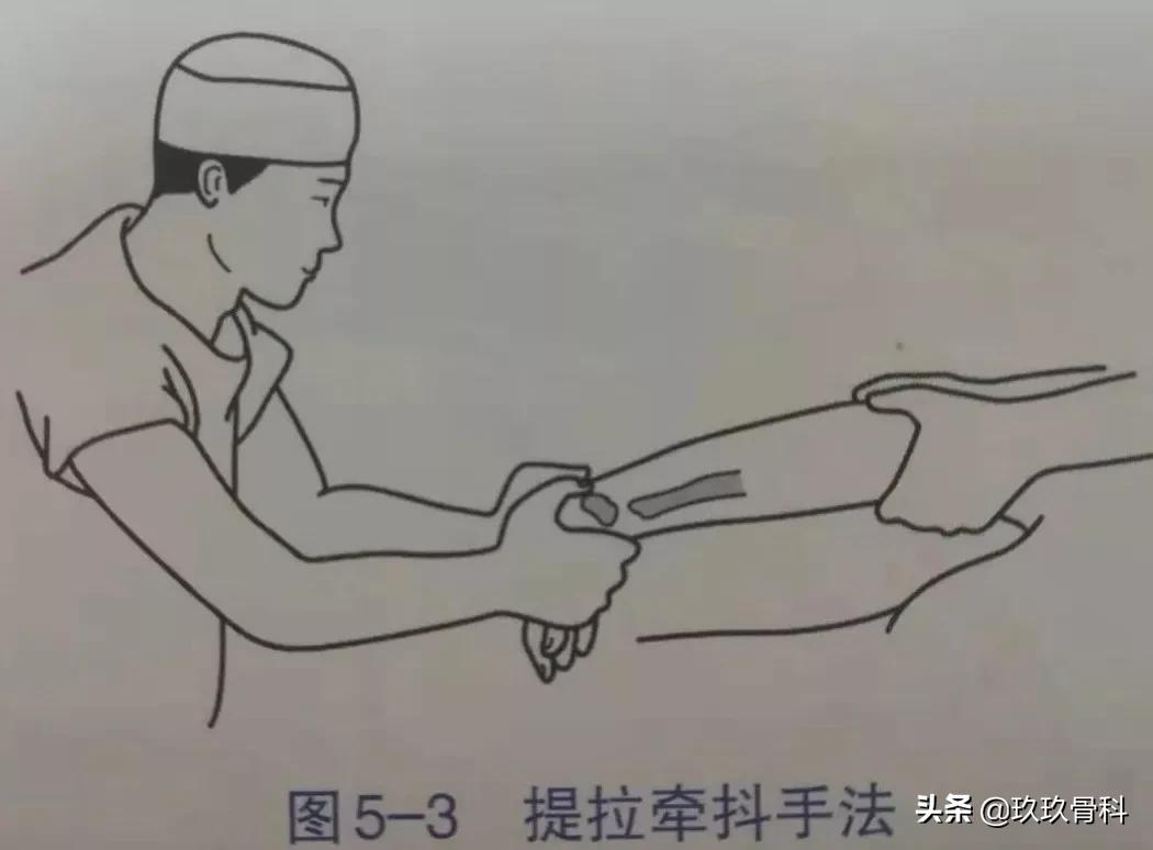 骨折手法整复术多少钱,骨折恢复手法视频教程