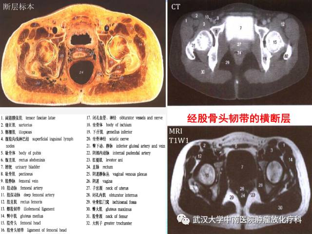 女性盆腔解剖与断层影像