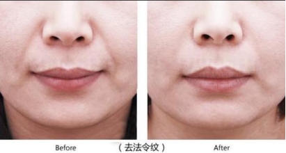 怎么隐藏身上纹,怎么隐藏泪沟法令纹